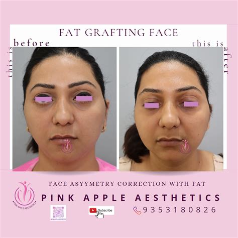 Fat Grafting Surgery in Bangalore | Natural Facial Rejuvenation