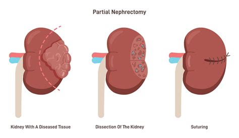 Image result for Nephrectomy Approach