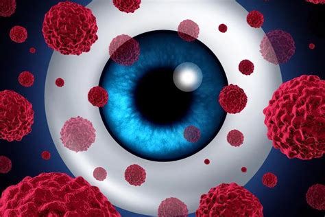 30 Facts About Intraocular Melanoma (Eye Cancer) - Facts.net
