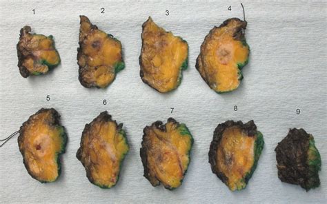 Fat necrosis of the breast | Atlas of Pathology