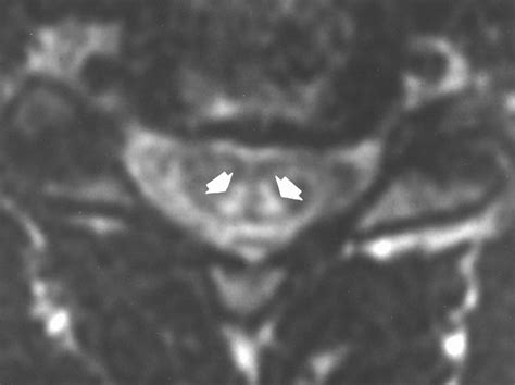 Subacute Combined Degeneration