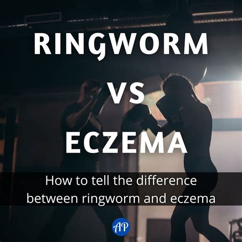 Treating Eczema Ringworm at Aileen Markham blog