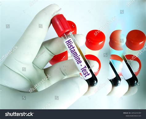 Blood Sample Tryptase Test Tryptase Test Foto stock 2251231307 ...