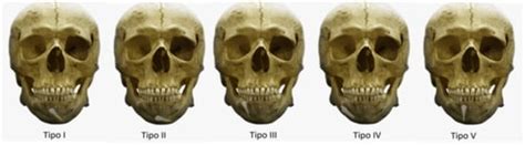 Dental Transmigration: An Observational Retrospective Study OF52 ...