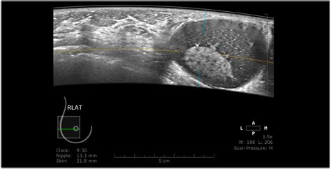 Pros and Cons for Automated Breast Ultrasound (ABUS): A Narrative Review