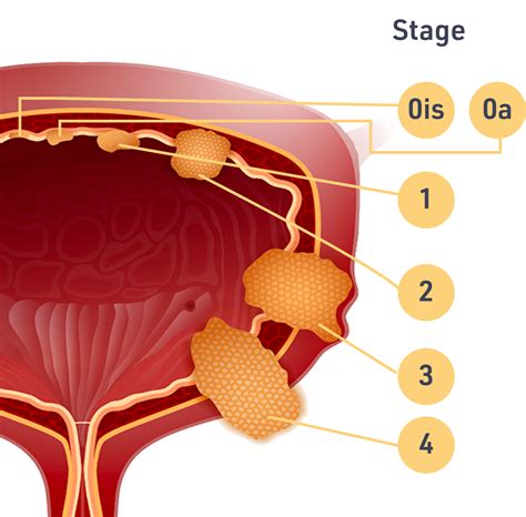 Bladder Cancer Stages
