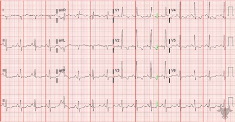 Pulmonary Embolism | ECG Stampede