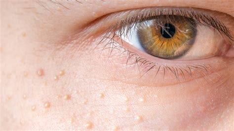 Milia Removal: The Causes Of The Tiny White Bumps On Your Face | Glamour UK