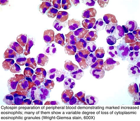 What Does Raised Eosinophils Mean at Brian Randell blog