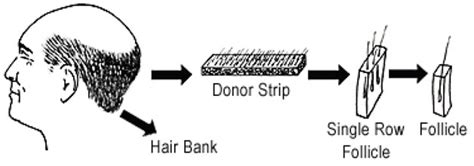 Depending on the process by which the grafts are collected, the ...