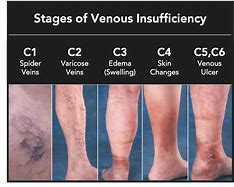 Image result for Venous