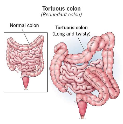 Tortuous Colon (Redundant Colon): What It Is & Symptoms - Wockr