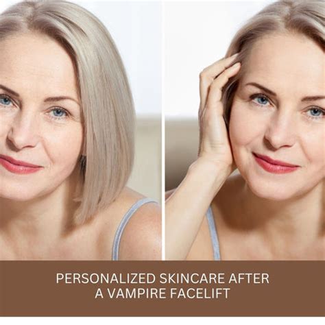 Exploring the Vampire Facelifts: A Comprehensive Guide | Clinikally