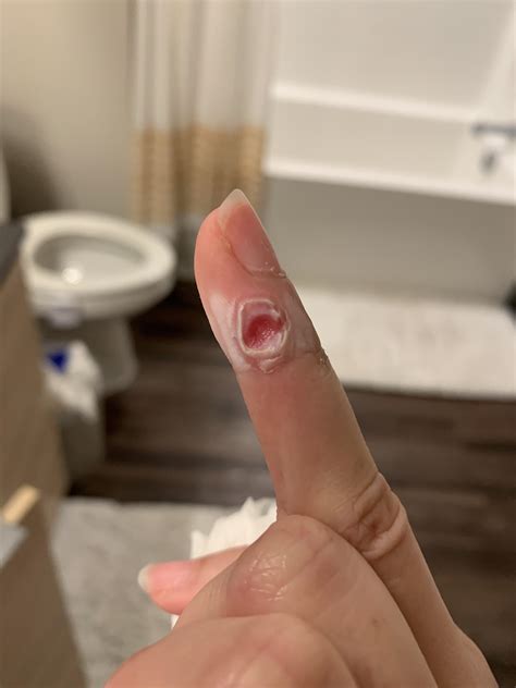 Image result for How Does Compound W Work