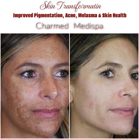 Understanding and Treating Melasma and Hyperpigmentation: Options at Charmed Medispa in Delaware ...