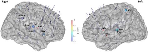 Transient alteration of Awareness triggered by direct electrical stimulation of the brain ...