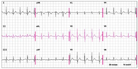 Image result for AFib Detection Algorithm