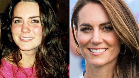 kate middleton surgery endometriosis