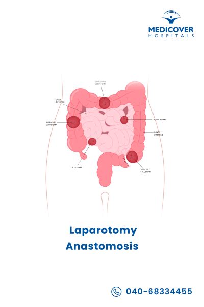 Anastomía por laparotomía | Tipos, procedimiento y recuperación