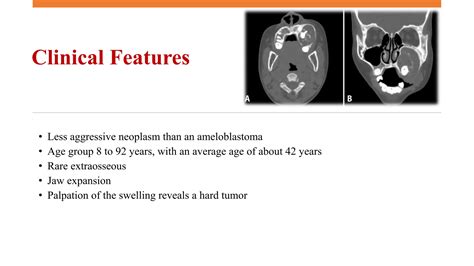 Adenomatoid odontogenic tumor, calcifying epithelial odontogenic tumors and calcifying ...