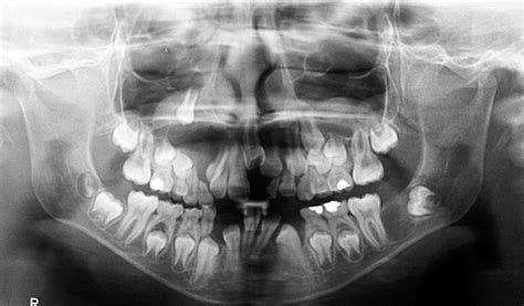 Keratocystic Odontogenic Tumor