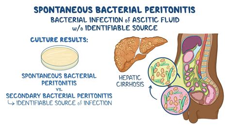 Spontaneous bacterial peritonitis: Video & Meaning | Osmosis