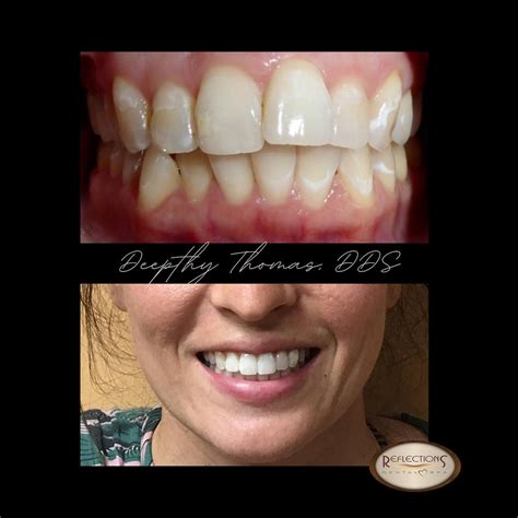 Invisalign Before & After - Reflections Dental Spa