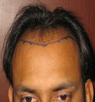 Before and After Photos - Case B010