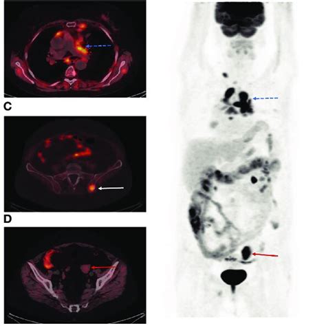 Image result for DOTA-TATE Scan