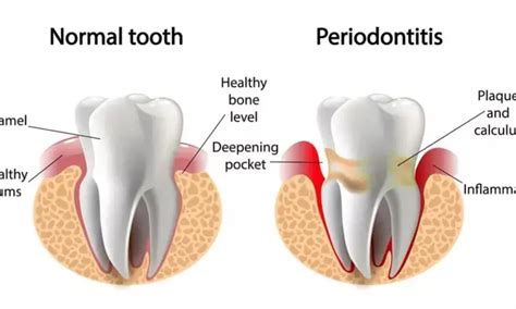 Salivary arginine and uric acid levels early indicators of periodontal ...