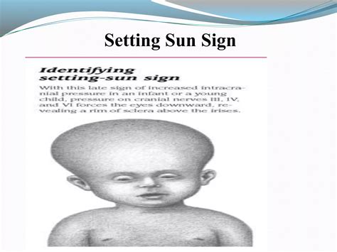 Hydrocephalus | PPTX