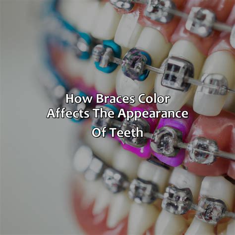 What Color Braces Make My Teeth Look White at Howard Jackson blog