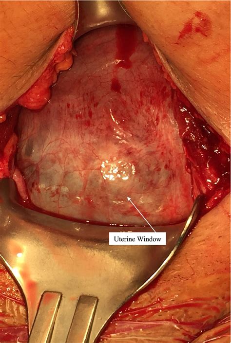 “Uterine Dehiscence: A Diagnostic Conundrum in Repeat Cesarean Deliveries” - Sarue - 2025 ...