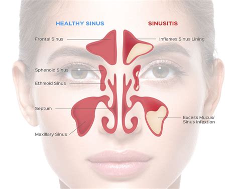 Sinusitis: 8 Symptoms That Indicate A Sinus Infection – VNUMS