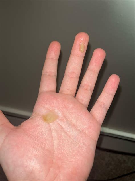 Coughing up orangish/yellowish/brownish phlegm? : r/medical