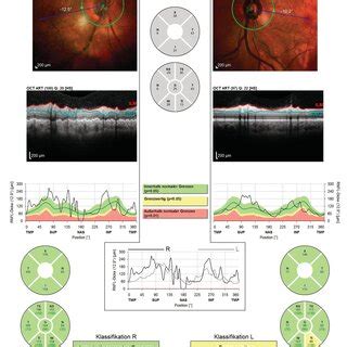 Image result for Paracentral Visual Field Defect