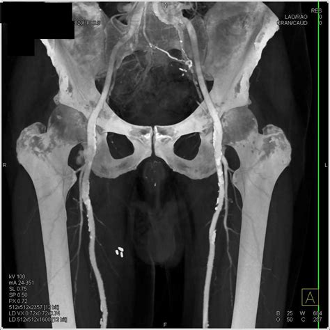Pseudo-Aneurysm of the Femoral Artery - Vascular Radiology Case Studies - CTisus CT Scanning