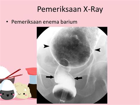 Image result for Modified Barium Swallow Video Example