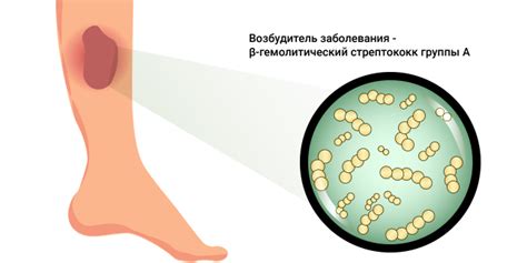 Пиодермия: типы, диагностика, лечение, препараты