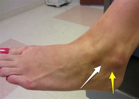 Sprained Ankle | Dr. David Geier - Sports Medicine Simplified