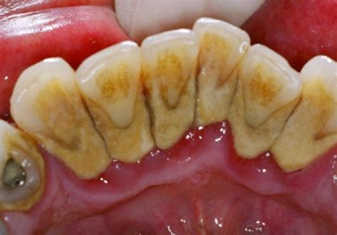 牙周是否健康 从颜色就能看出_美哈口腔