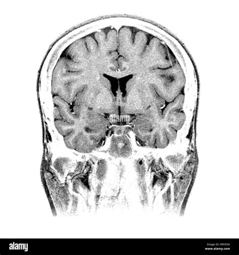 Normal brain mri Black and White Stock Photos & Images - Alamy