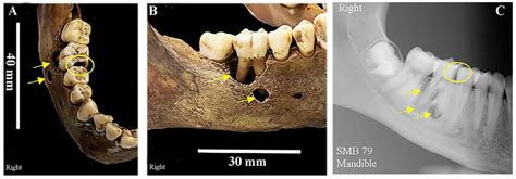 The Oral Health of a Group of 19th Century South Australian Settlers in ...