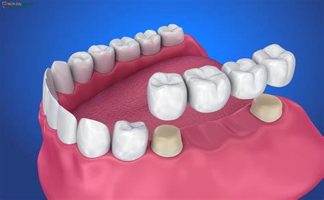 Dental Bridge: Restore Your Smile with Expert Solutions | Dr. Cuong - Ho Chi Minh City Dental Clinic