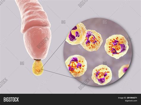 Gonorrhea Incubation Period In Men