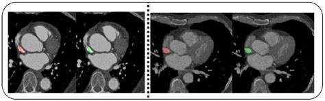 Detecting Coronary Artery Disease from Computed Tomography Images Using ...