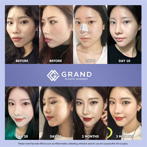 This lady gained more sophisticated look and delicate features though Grand's facial contouring ...