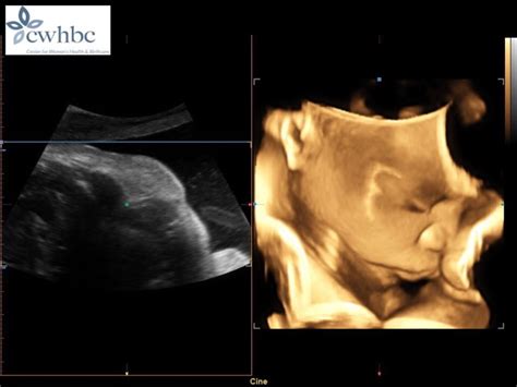 Bildergebnis für umbilical cord wrapped around neck