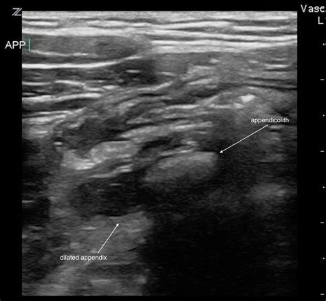 Appendicitis Ultrasound Criteria