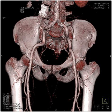 Right Hip Joint Effusion and Normal CTA - Musculoskeletal Radiology ...